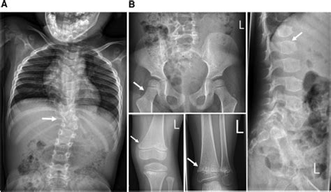Mutations In Fibronectin Cause A Subtype Of Spondylometaphyseal