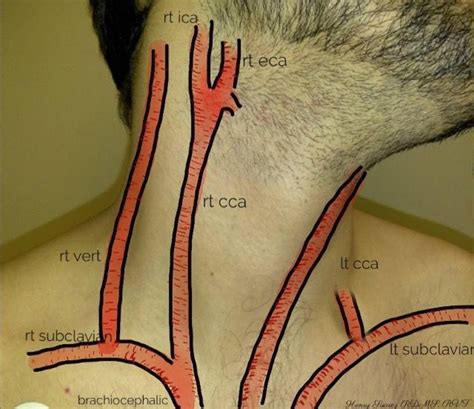 This article describes the anatomy of the head and neck of the human body, including the brain, bones, muscles, blood vessels, nerves, glands, nose, mouth, teeth, tongue, and throat. Neck arteries | Diagnostic medical sonography, Vascular ...