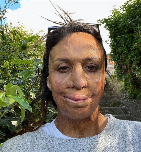 Turia Pitt Opens Up About Life Changing Fire That Saw Almost Burnt Her Alive Years On Daily