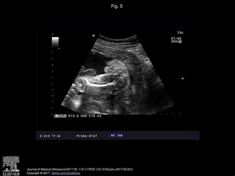 Prenatal Diagnosis Of Hypospadias A Case Report Ppt Download
