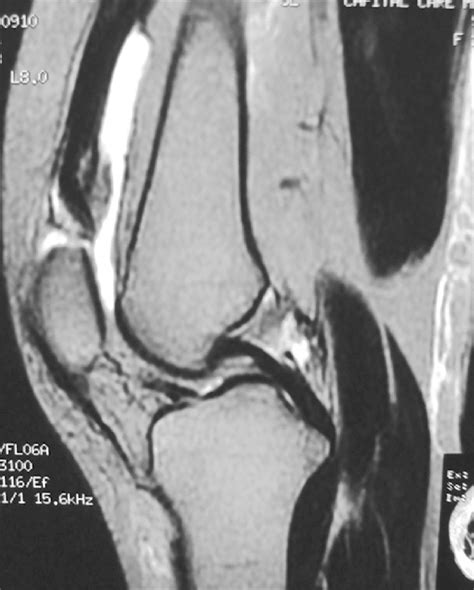 T2 Weighted Sagittal Mr Image Of Right Knee Showing Discontinuity