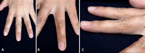 A Multiple Brown Pigmented Patches On The Left Hand B Homogeneous