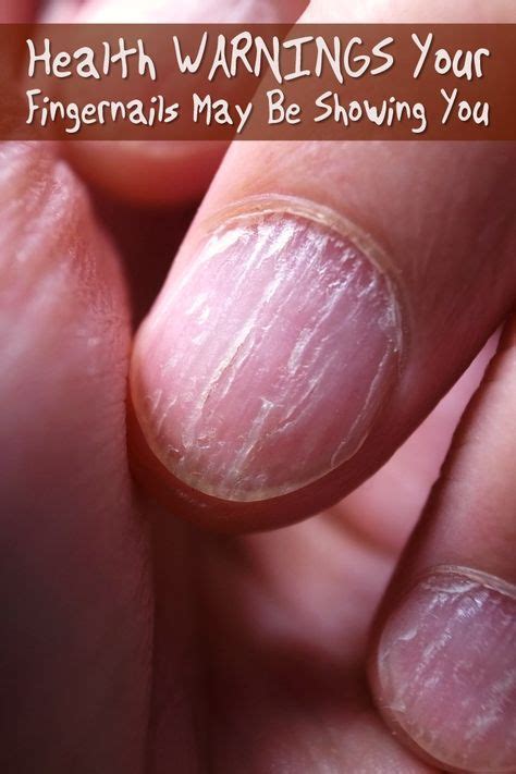 Health Warnings Your Fingernails May Be Showing You The Little Flaws