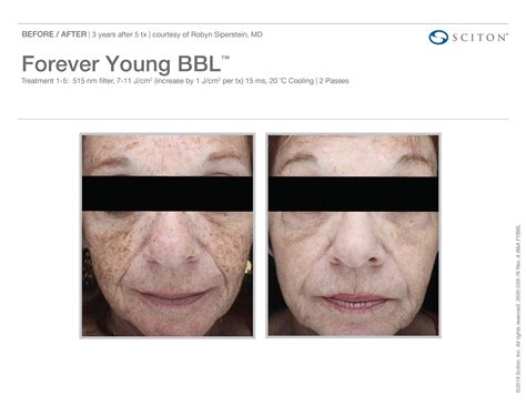 Bbl Forever Young Emerge Health And Wellness Medical Spa