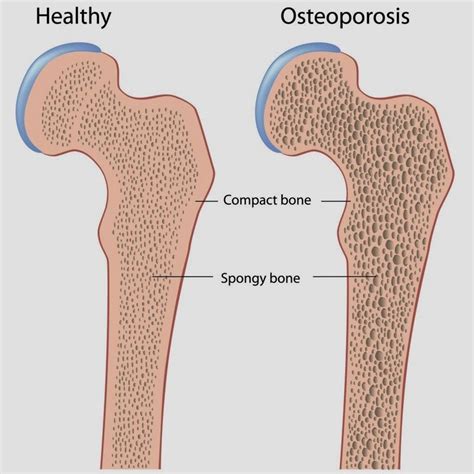Healthy bones vs. osteoporosis | Osteoporosis treatment, Osteoporosis