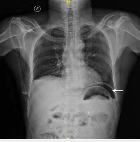 X Ray Of The Chest And Abdomen Showing Gas Under The Diaphragm