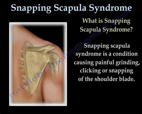 Snapping Scapula Syndrome Everything You Need To Know Nabil