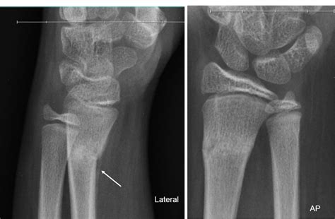 Torus Fracture Radiology Cases