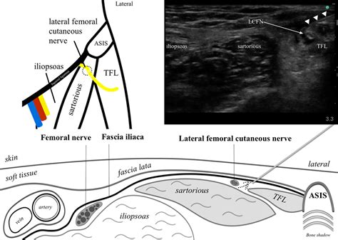 Lateral Femoral Cutaneous Block — Highland Em Ultrasound Fueled Pain