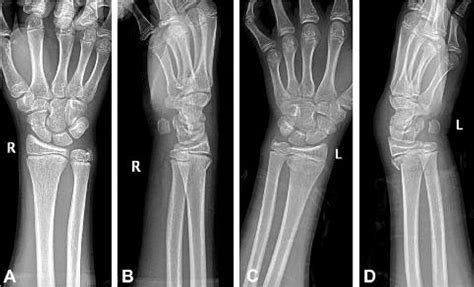 Ap And Lateral Radiographs Of The Right A B And Left C