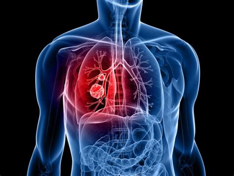Common Causes Of Lung Cancer Detailed Review