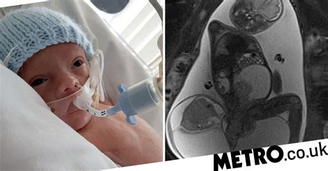 Baby Born With Tumour The Same Size As His Body Metro News