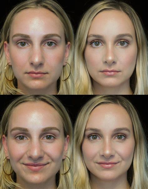 The Complete Guide To Rhinoplasty Rhinoplasty Before And After