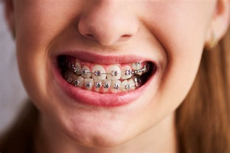 5 Reasons To Get Braces Somos Dental Phoenix Az