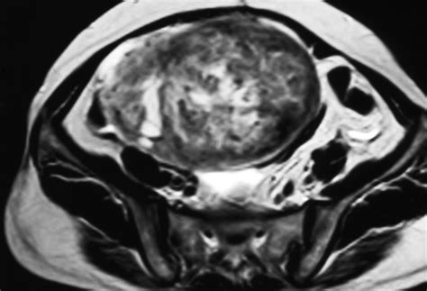 Ct And Mri Findings Of Sex Cordstromal Tumor Of The Ovary Ajr