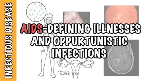 Opportunistic Infections And Aids Defining Illnesses Cd4 Cell Count