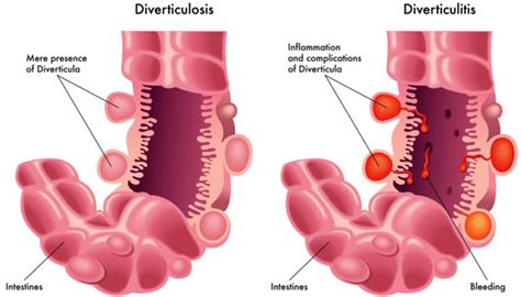 Diverticulitis Causes Symptoms Prevention Diverticulitis Diet Treatment