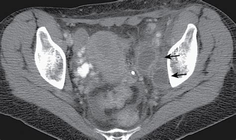 Lymphadenopathy Radiology Key