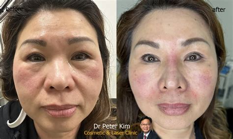 Liquid Face Lift Restore Volume Injection Dr Peter Kim Surgery