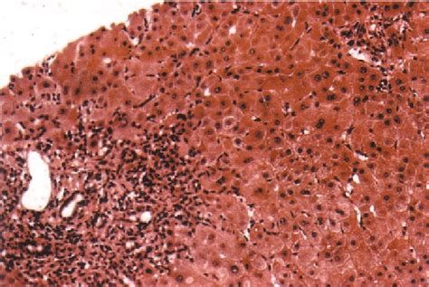 Histology Of Nodular Regenerative Hyperplasia With Multiple