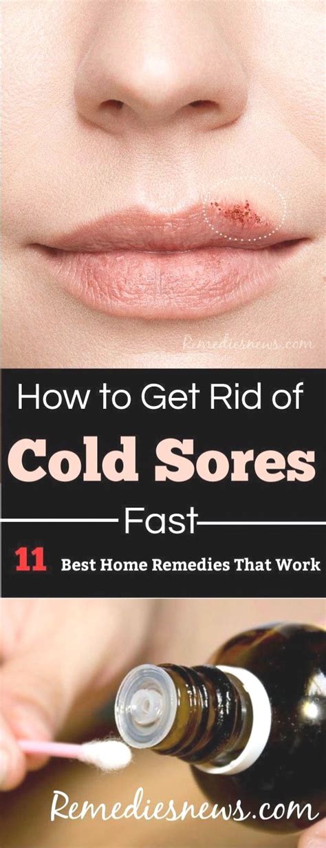25 Powerful Home Remedies In 2020 Cold Sore Cold Sore Treatment