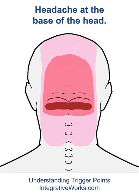 There are lymph glands in the lower back. Understanding Trigger Points - Headache at the back of your head (With images) | Trigger points ...