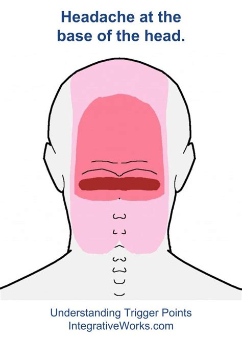 The headaches still occur when i bend over, cough or jump up and down. Understanding Trigger Points - Headache at the back of ...