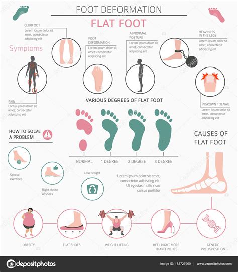 Deformação Do Pé Como Infográfico De Doença Médica Causas De Flat