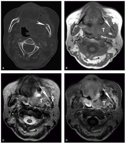 Imaging Of Head And Neck Cancer Oncohema Key