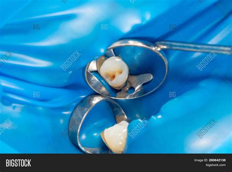 Dental Caries Filling Image And Photo Free Trial Bigstock