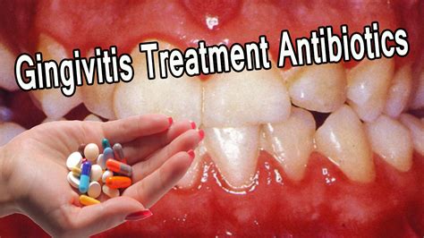 Gingivitis Treatment Antibiotics