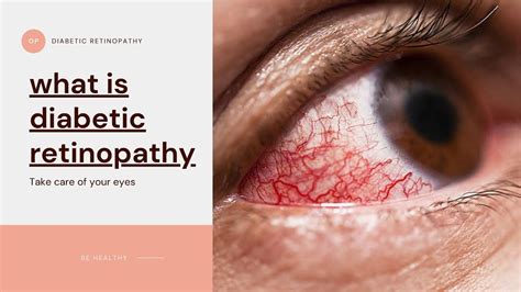 What Is Diabetic Retinopathy Symptoms Prevention Cause Treatment
