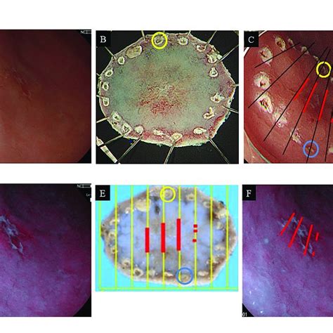 Endoscopic Images Of Gastric Cancer On The Anterior Wall Of The