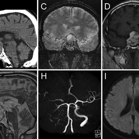 Preoperative Imaging Axial Noncontrast Ct Scan A Showing A Slightly