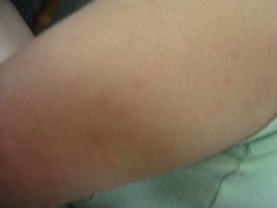 Maybe you would like to learn more about one of these? Detergent Allergy Pictures: Find Out If You're Allergic To ...