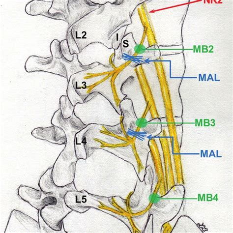 Rfa Of The L3 And L4 Medial Branches And L5 Dorsal Ramus A Slightly