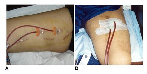 Vascular Access For Hemodialysis Pictures