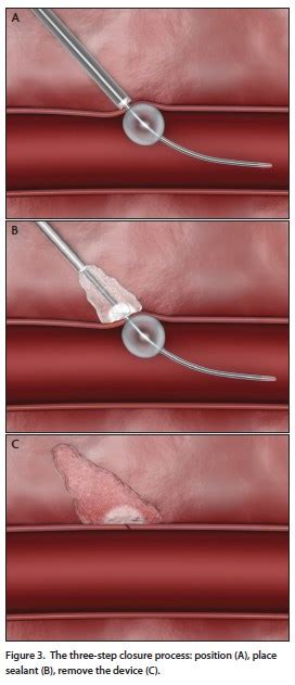 Endovascular Today The Mynx Ace Vascular Closure Device February 2015