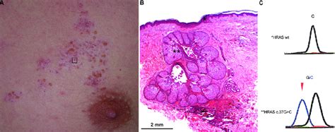 Clinical Histological And Genetic Findings Of A Sebaceous Naevus 5