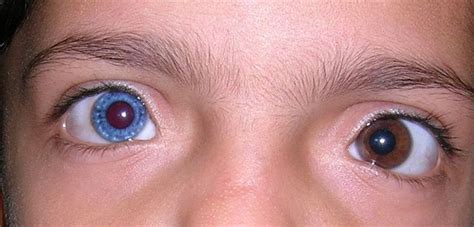 Heterochromia Different Colored Eyes Heterochromia Iridum