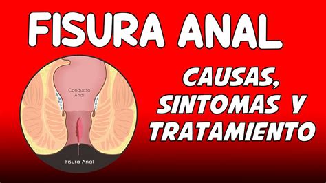 La Fisura Anal Causas Síntomas Diagnóstico Y Tratamiento Youtube