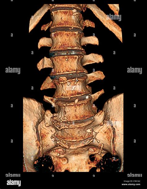 Degenerative Disc Disease 3d Ct Scan Stock Photo 40085418 Alamy