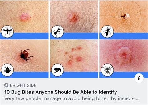 Bug Bites Anyone Should Be Able To Identify Bug Bites Household Hacks Bugs