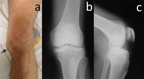 The raiders were gonna win last week. A giant medial parameniscal cyst of the knee joint | BMJ ...