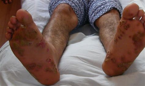 Search only for rieters syndrome Clinical tetrad of arthritis, urethritis, conjunctivitis ...