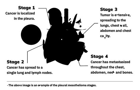 The iaslc mesothelioma staging project: 4 Mesothelioma Stages | Staging Systems & Treatment by Stage