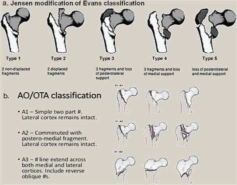 Overview Of Classification And Surgical Management Of Hip Fractures