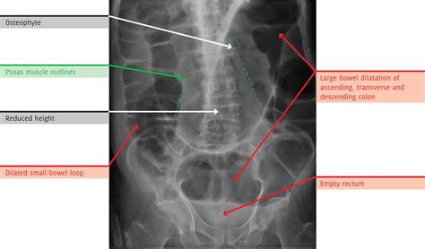 The Unofficial Guide To Radiology 100 Practice Abdominal X Rays