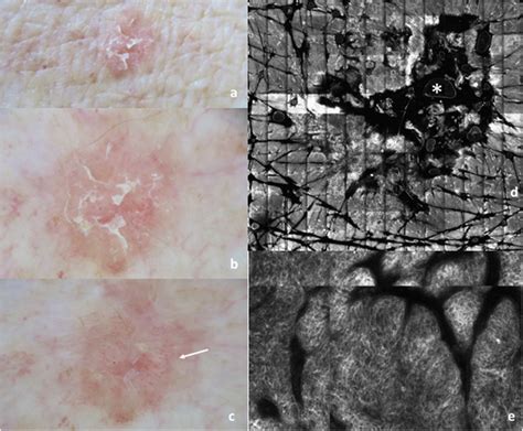 In Situ Squamous Cell Carcinoma A Clinical Image Of An In Situ Scc On