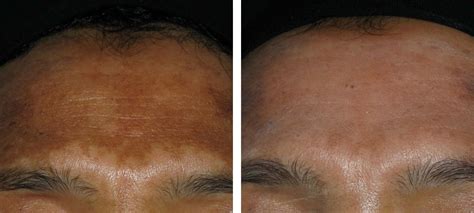 Pigmentation Before And After Kingsway Dermatology